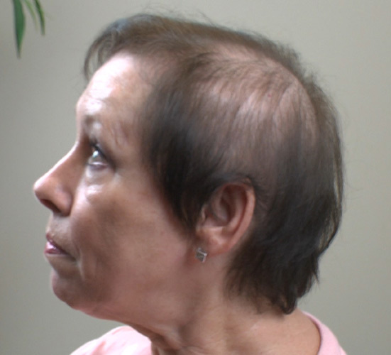 does propecia regrow hair in the front